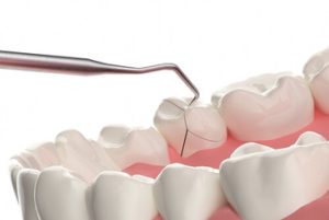 Cracked Tooth Filling symptoms croydon